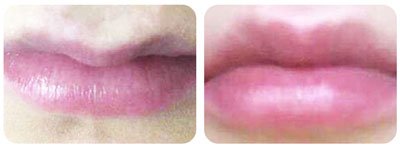 Lip Enhancement 